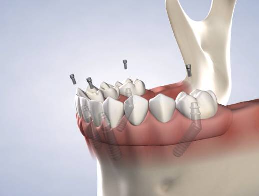 Learn about full-arch restoration at Beech & Reid Oral & Dental Implant Surgery