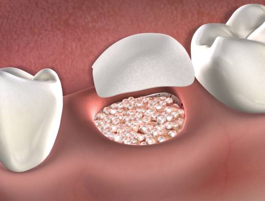 Learn about bone grafting at Beech & Reid Oral & Dental Implant Surgery