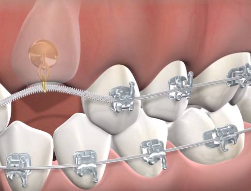 Learn about impacted canines at Beech & Reid Oral & Dental Implant Surgery