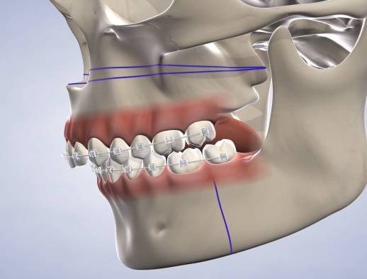 Learn about jaw surgery at Beech & Reid Oral & Dental Implant Surgery